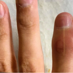 Artrite psoriasica: quali sono i primi sintomi e come si cura?