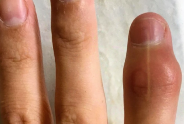 psoriatic-arthritis-1-yaseen-master_it